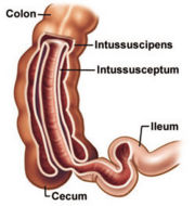 180px Intussusception