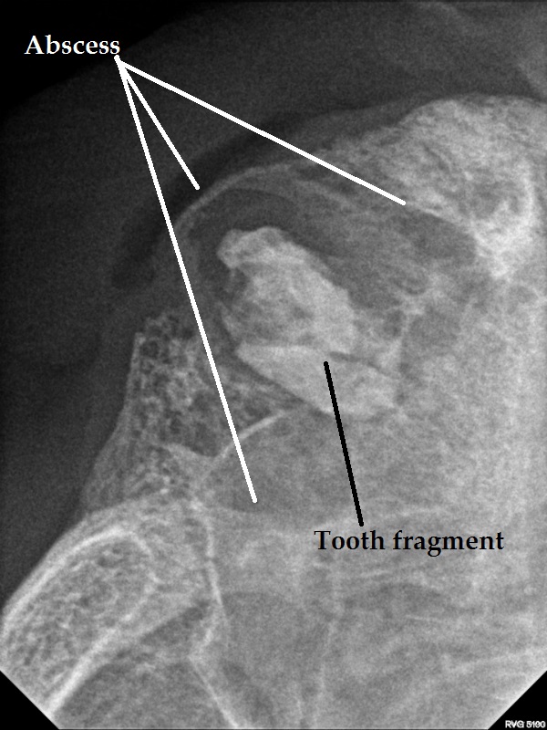 2. Dental Xray with fragment