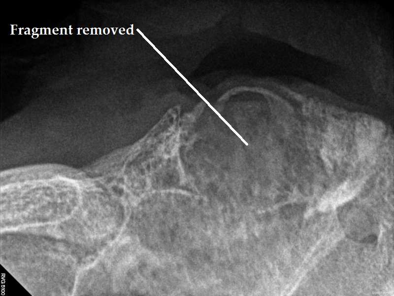 3. Dental xray after fragment removal