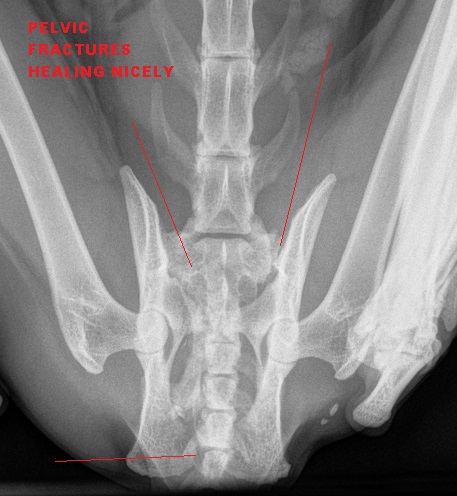 8.PELVIC FRACTURES HEALING ONE MONTH LATER
