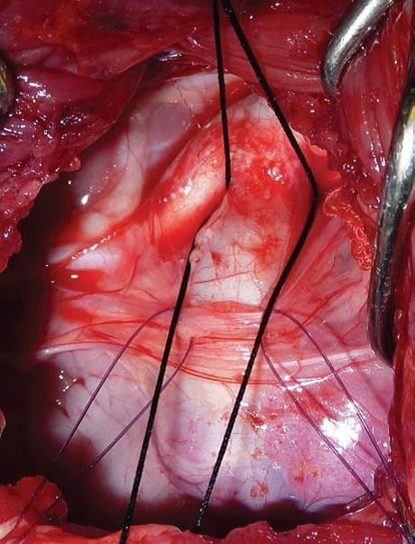 Intraoperative heart