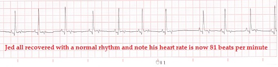 Jed recovery ecg edit