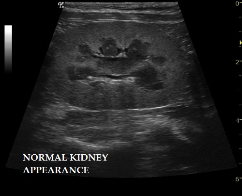 Normal Kidney