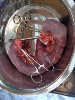 Removed Uterus