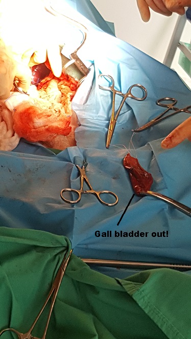 gall bladder removed